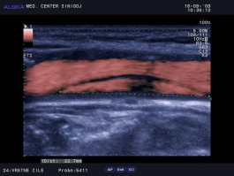 Ultrazvok vratnih žil - disekcija karotide 22,7mm